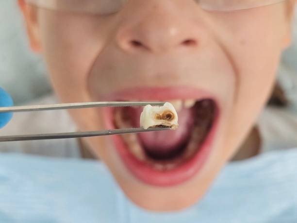 Best Emergency Tooth Extraction in Upper Fruitland, NM